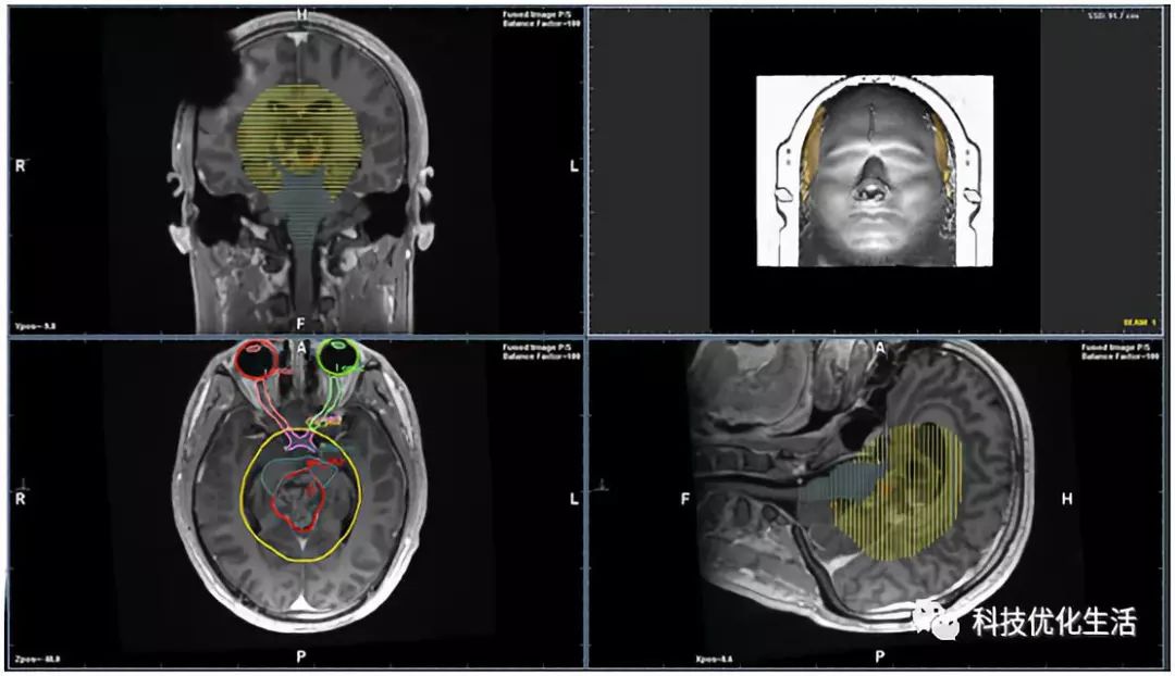 人工智能之AI如何改变癌症治疗 人工智能之AI如何改变癌症治疗