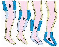 医用气体流量传感器在空气波压力治疗仪中应用